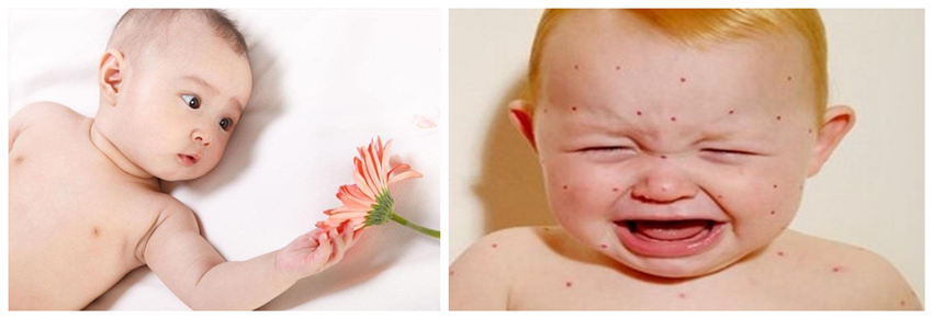 兒童濕疹反反復復，您有在家安裝家用除濕產品嗎？_重復